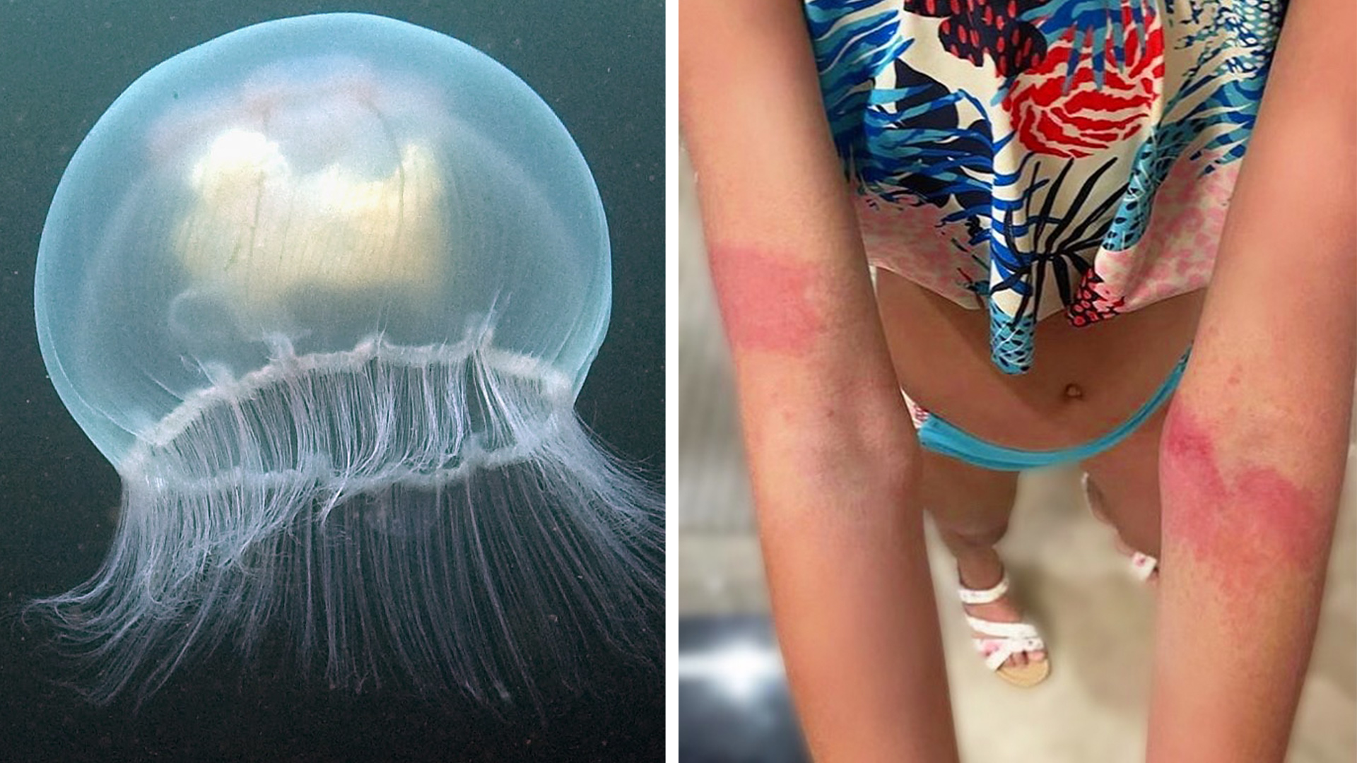 Qué hacer si te pica una medusa cuando vas a la playa en Galveston Qué hacer si te pica una medusa cuando vas a la playa en Galveston